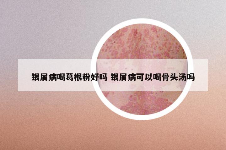 银屑病喝葛根粉好吗 银屑病可以喝骨头汤吗