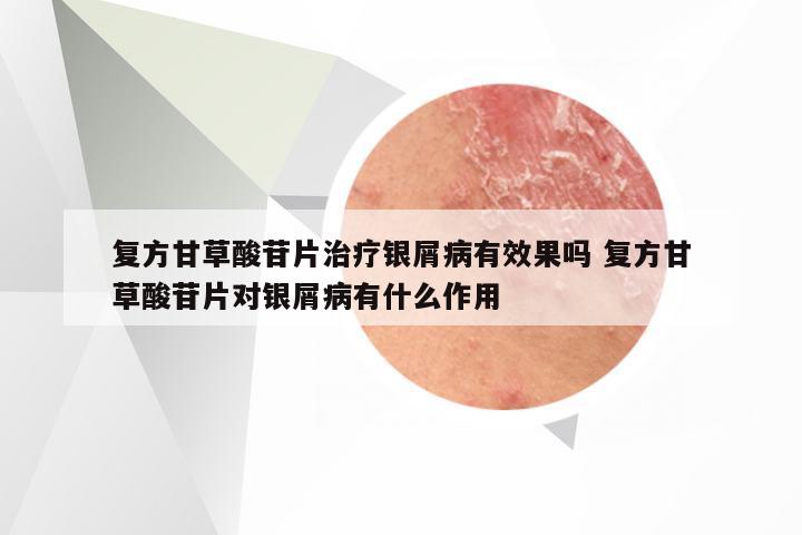 复方甘草酸苷片治疗银屑病有效果吗 复方甘草酸苷片对银屑病有什么作用
