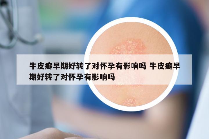 牛皮癣早期好转了对怀孕有影响吗 牛皮癣早期好转了对怀孕有影响吗