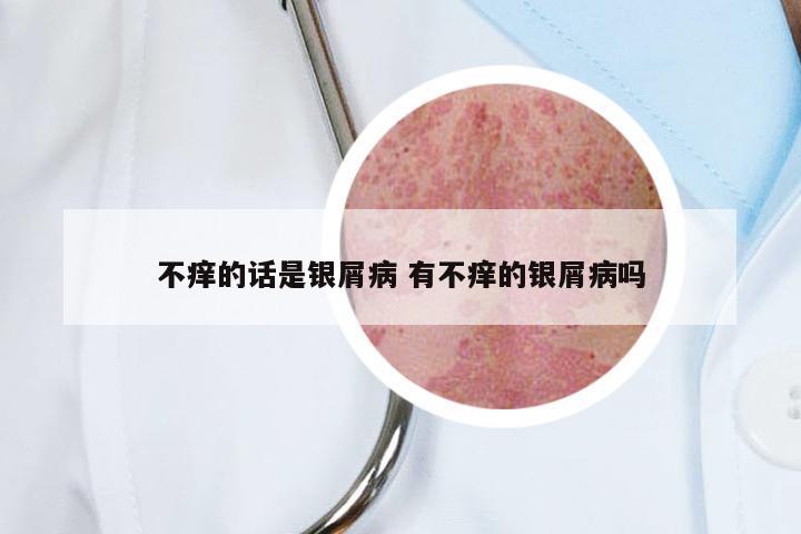 不痒的话是银屑病 有不痒的银屑病吗