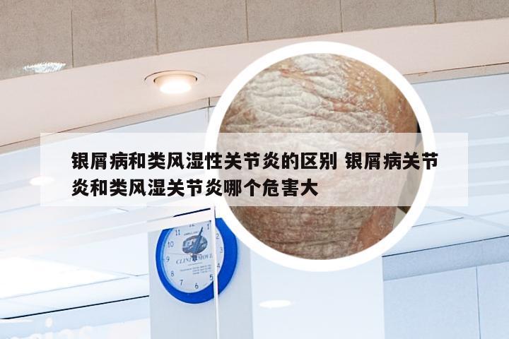 银屑病和类风湿性关节炎的区别 银屑病关节炎和类风湿关节炎哪个危害大