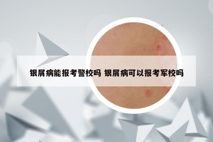 银屑病能报考警校吗 银屑病可以报考军校吗