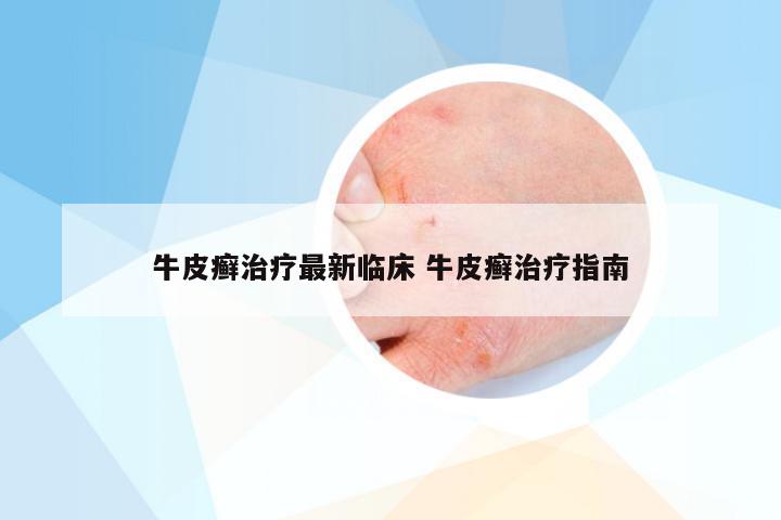 牛皮癣治疗最新临床 牛皮癣治疗指南