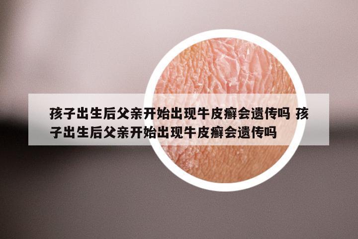 孩子出生后父亲开始出现牛皮癣会遗传吗 孩子出生后父亲开始出现牛皮癣会遗传吗