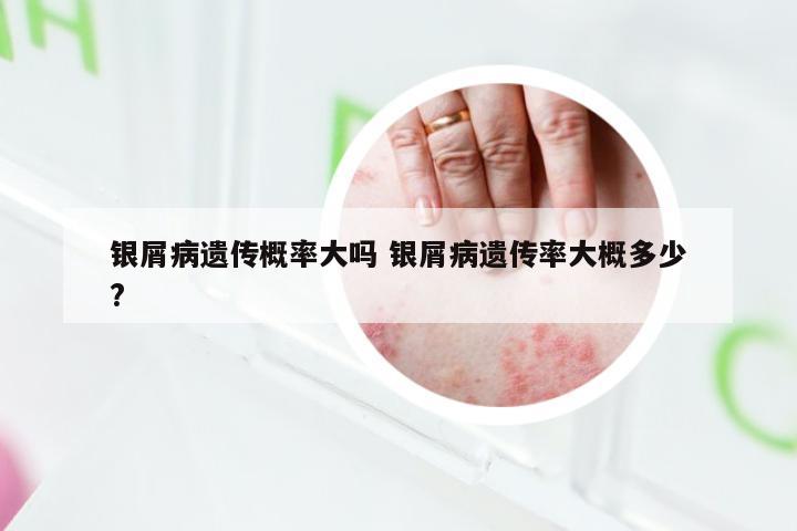 银屑病遗传概率大吗 银屑病遗传率大概多少?