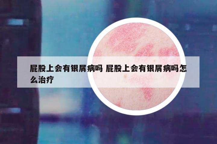 屁股上会有银屑病吗 屁股上会有银屑病吗怎么治疗