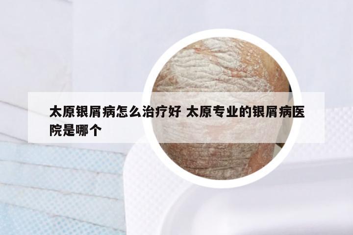 太原银屑病怎么治疗好 太原专业的银屑病医院是哪个