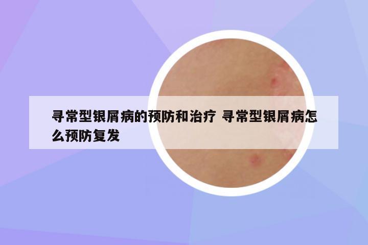 寻常型银屑病的预防和治疗 寻常型银屑病怎么预防复发