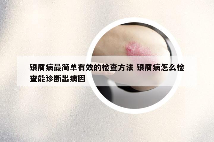 银屑病最简单有效的检查方法 银屑病怎么检查能诊断出病因