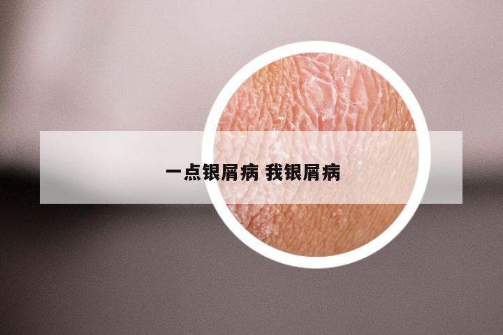 一点银屑病 我银屑病