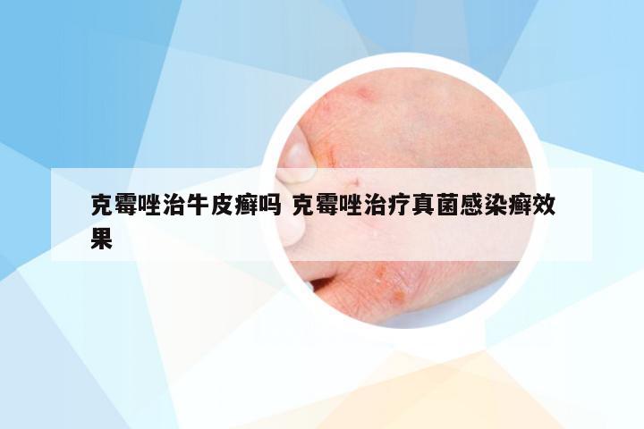 克霉唑治牛皮癣吗 克霉唑治疗真菌感染癣效果