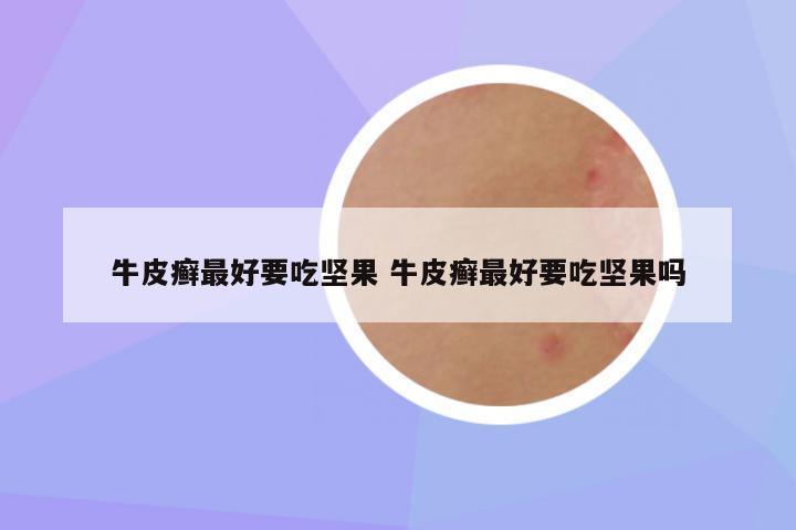 牛皮癣最好要吃坚果 牛皮癣最好要吃坚果吗