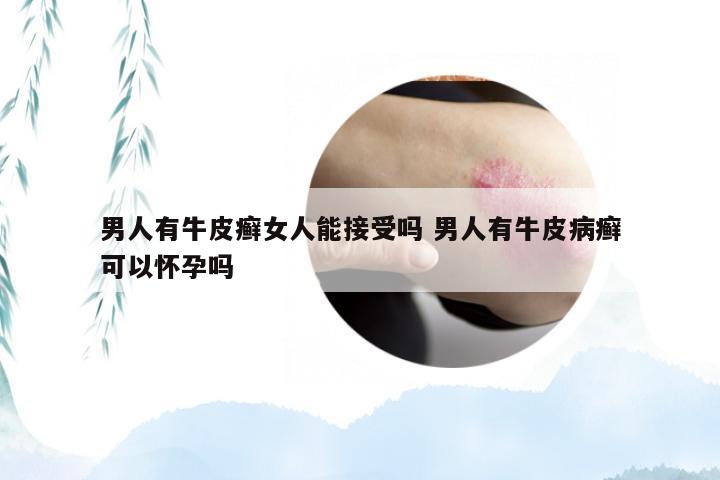 男人有牛皮癣女人能接受吗 男人有牛皮病癣可以怀孕吗