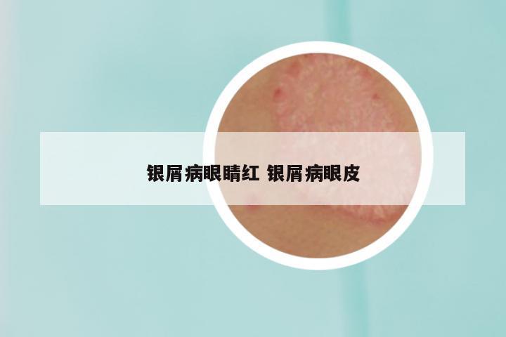银屑病眼睛红 银屑病眼皮