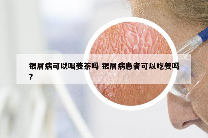 银屑病可以喝姜茶吗 银屑病患者可以吃姜吗?