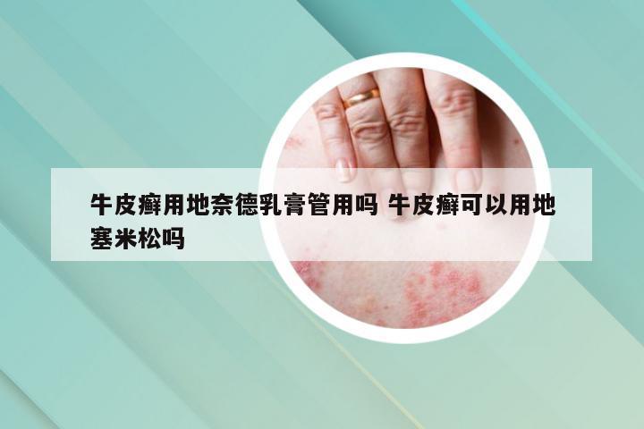 牛皮癣用地奈德乳膏管用吗 牛皮癣可以用地塞米松吗