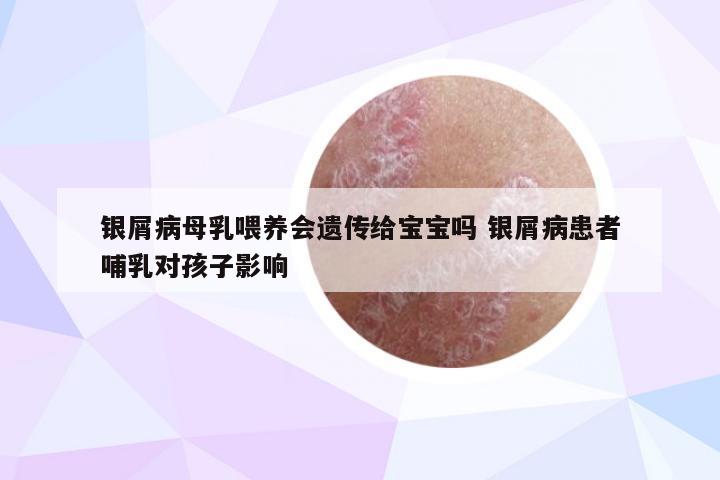 银屑病母乳喂养会遗传给宝宝吗 银屑病患者哺乳对孩子影响