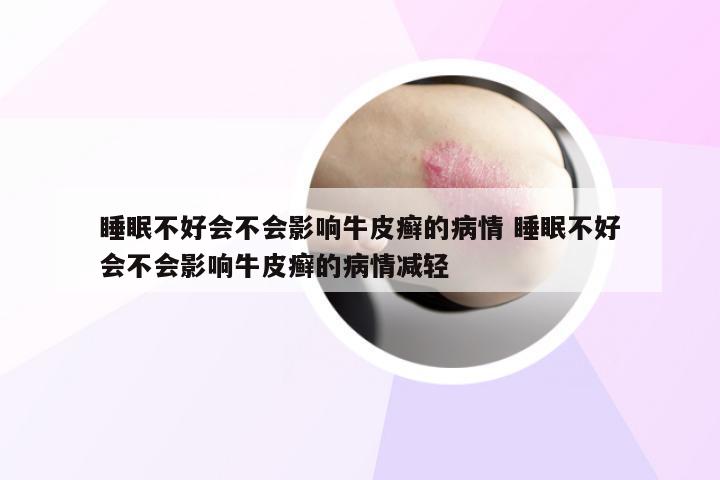 睡眠不好会不会影响牛皮癣的病情 睡眠不好会不会影响牛皮癣的病情减轻