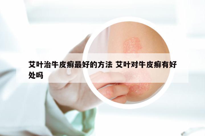 艾叶治牛皮癣最好的方法 艾叶对牛皮癣有好处吗