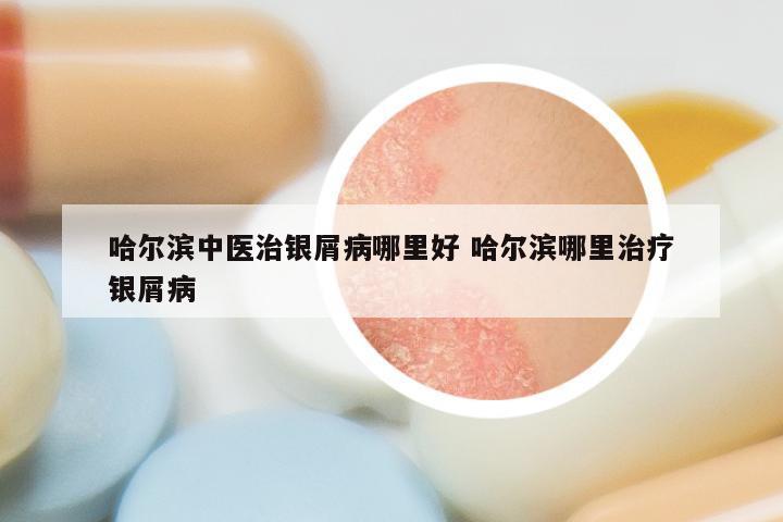 哈尔滨中医治银屑病哪里好 哈尔滨哪里治疗银屑病