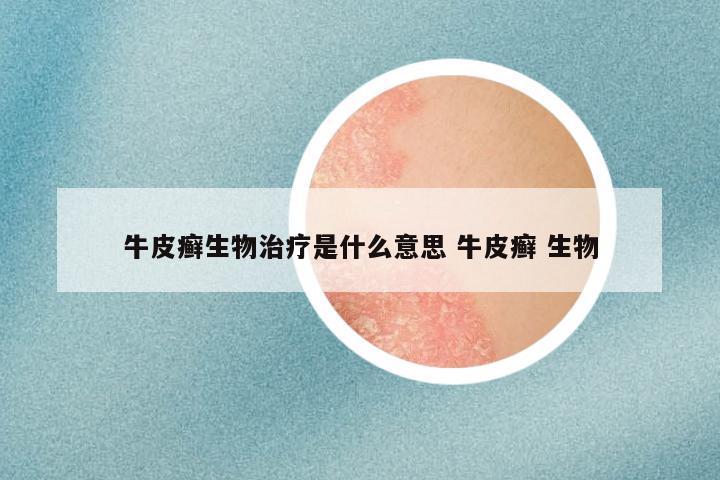 牛皮癣生物治疗是什么意思 牛皮癣 生物