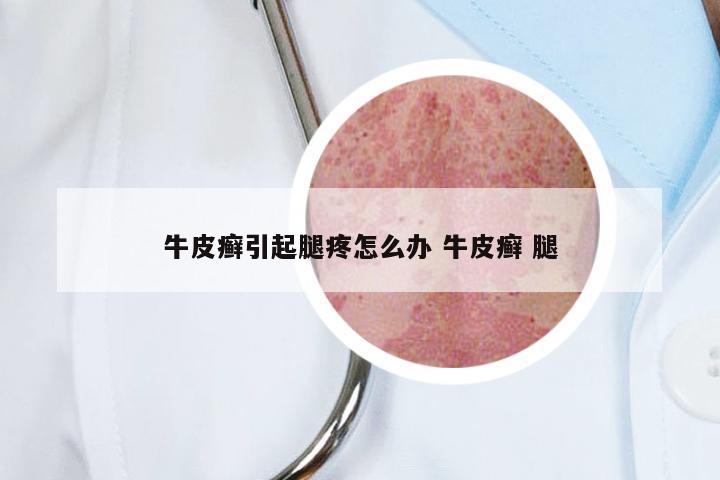 牛皮癣引起腿疼怎么办 牛皮癣 腿