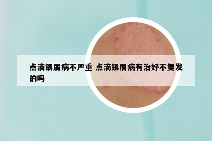 点滴银屑病不严重 点滴银屑病有治好不复发的吗