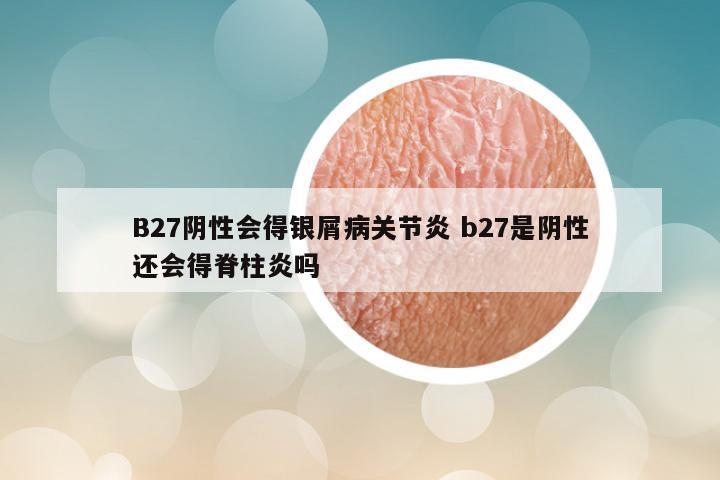 B27阴性会得银屑病关节炎 b27是阴性还会得脊柱炎吗
