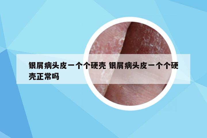 银屑病头皮一个个硬壳 银屑病头皮一个个硬壳正常吗