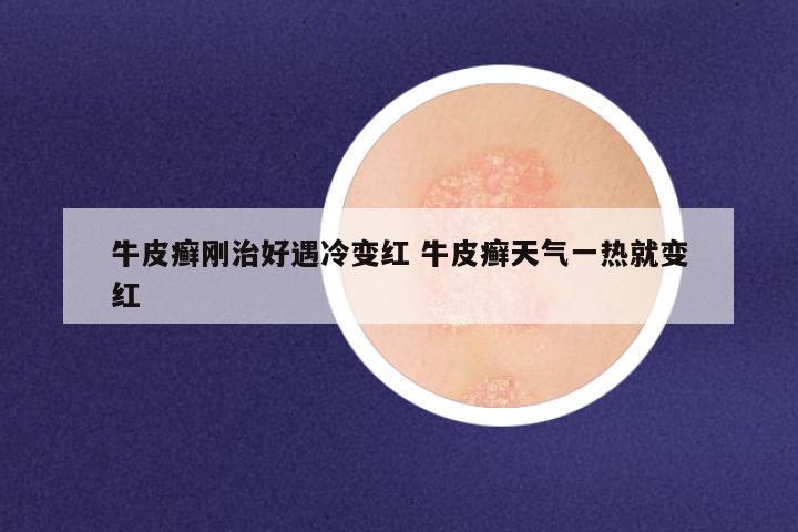 牛皮癣刚治好遇冷变红 牛皮癣天气一热就变红