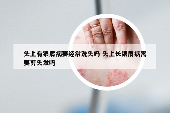 头上有银屑病要经常洗头吗 头上长银屑病需要剪头发吗
