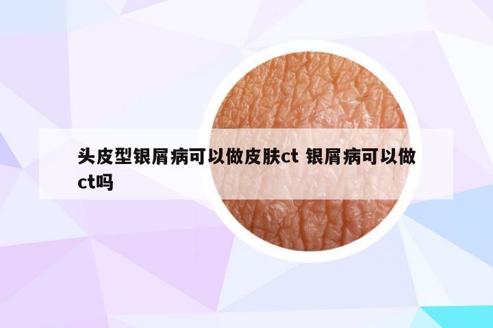 头皮型银屑病可以做皮肤ct 银屑病可以做ct吗