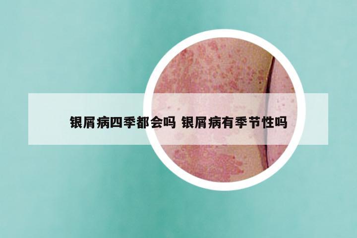 银屑病四季都会吗 银屑病有季节性吗