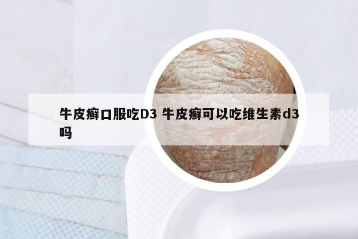 牛皮癣口服吃D3 牛皮癣可以吃维生素d3吗