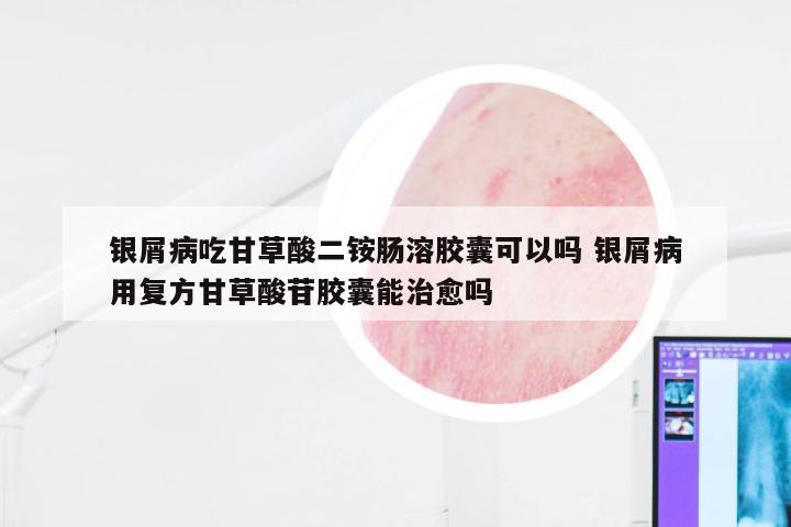 银屑病吃甘草酸二铵肠溶胶囊可以吗 银屑病用复方甘草酸苷胶囊能治愈吗