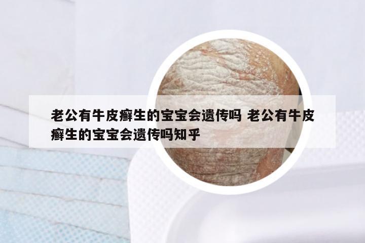 老公有牛皮癣生的宝宝会遗传吗 老公有牛皮癣生的宝宝会遗传吗知乎