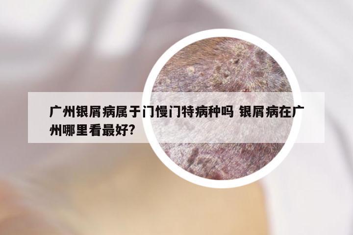 广州银屑病属于门慢门特病种吗 银屑病在广州哪里看最好?