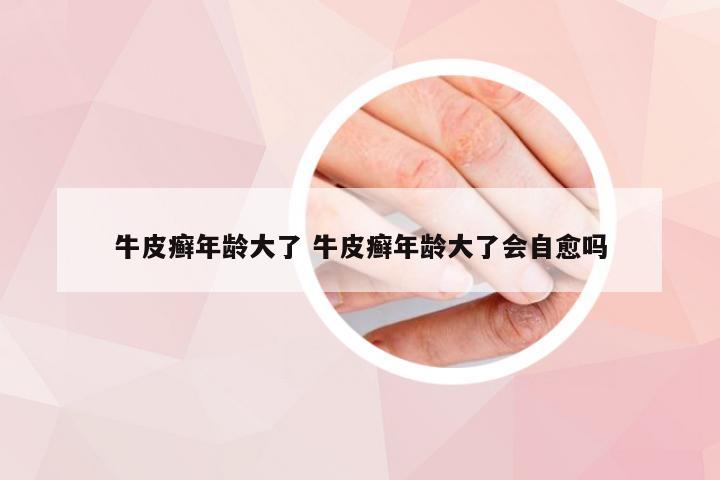 牛皮癣年龄大了 牛皮癣年龄大了会自愈吗