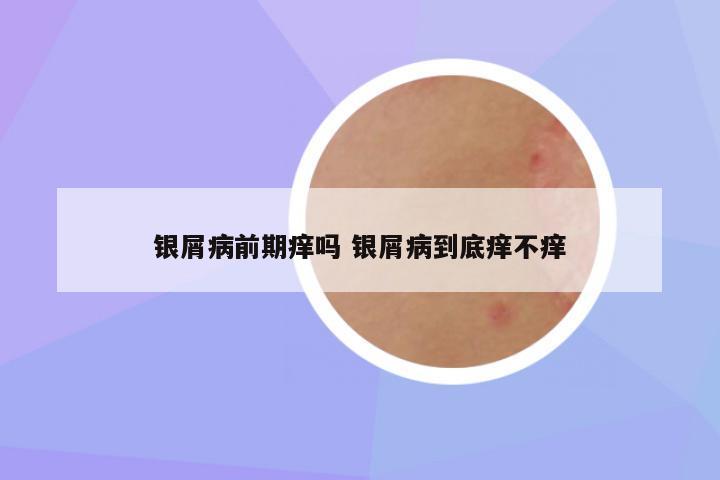 银屑病前期痒吗 银屑病到底痒不痒