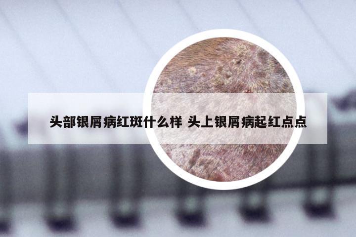 头部银屑病红斑什么样 头上银屑病起红点点