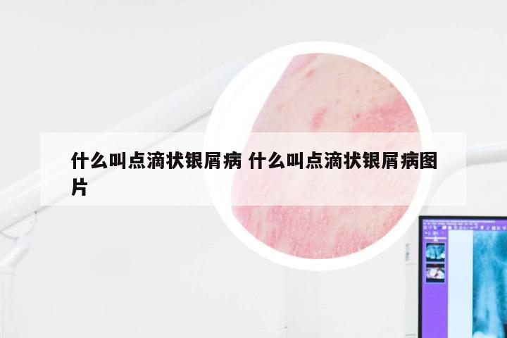 什么叫点滴状银屑病 什么叫点滴状银屑病图片