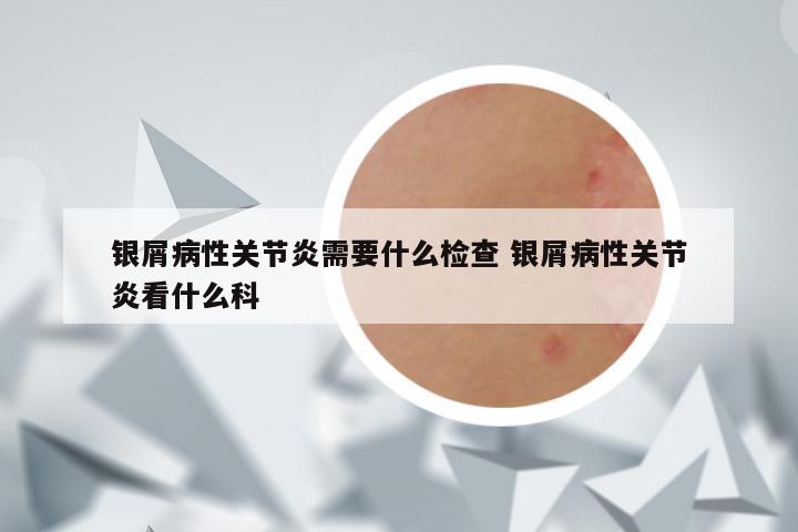 银屑病性关节炎需要什么检查 银屑病性关节炎看什么科