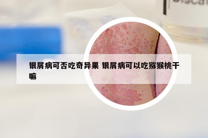 银屑病可否吃奇异果 银屑病可以吃猕猴桃干嘛