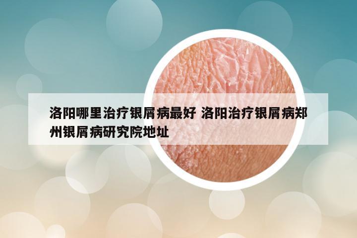 洛阳哪里治疗银屑病最好 洛阳治疗银屑病郑州银屑病研究院地址