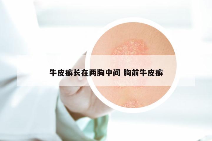牛皮癣长在两胸中间 胸前牛皮癣