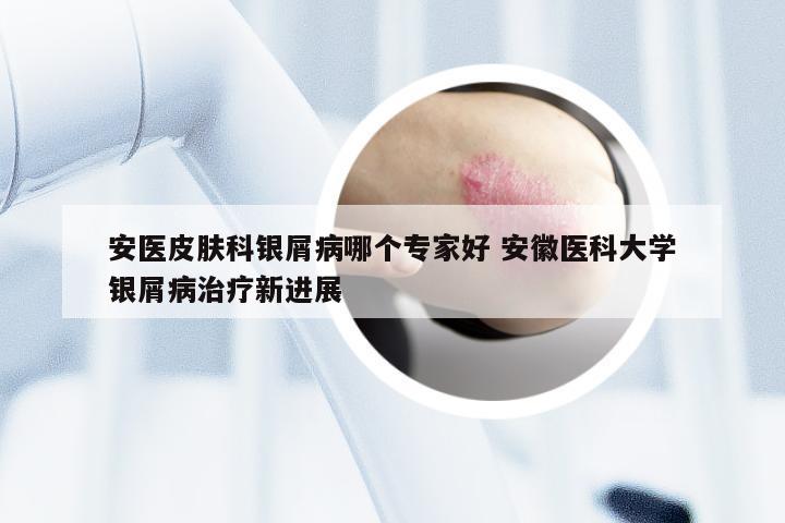 安医皮肤科银屑病哪个专家好 安徽医科大学银屑病治疗新进展