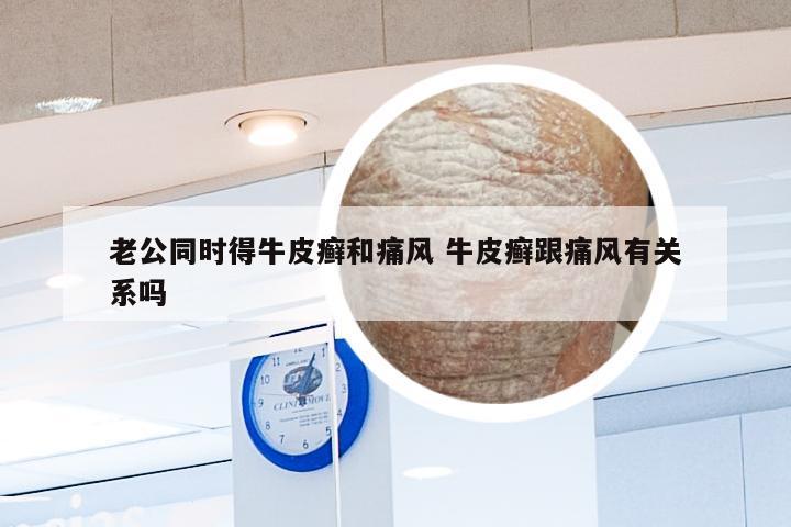 老公同时得牛皮癣和痛风 牛皮癣跟痛风有关系吗