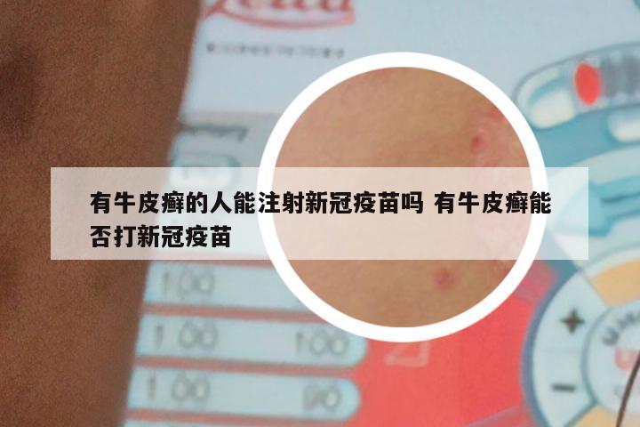 有牛皮癣的人能注射新冠疫苗吗 有牛皮癣能否打新冠疫苗