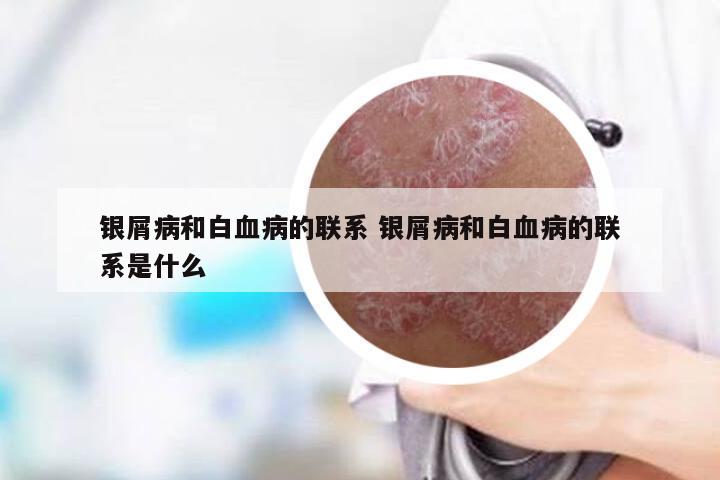 银屑病和白血病的联系 银屑病和白血病的联系是什么