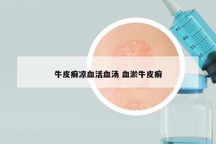 牛皮癣凉血活血汤 血淤牛皮癣